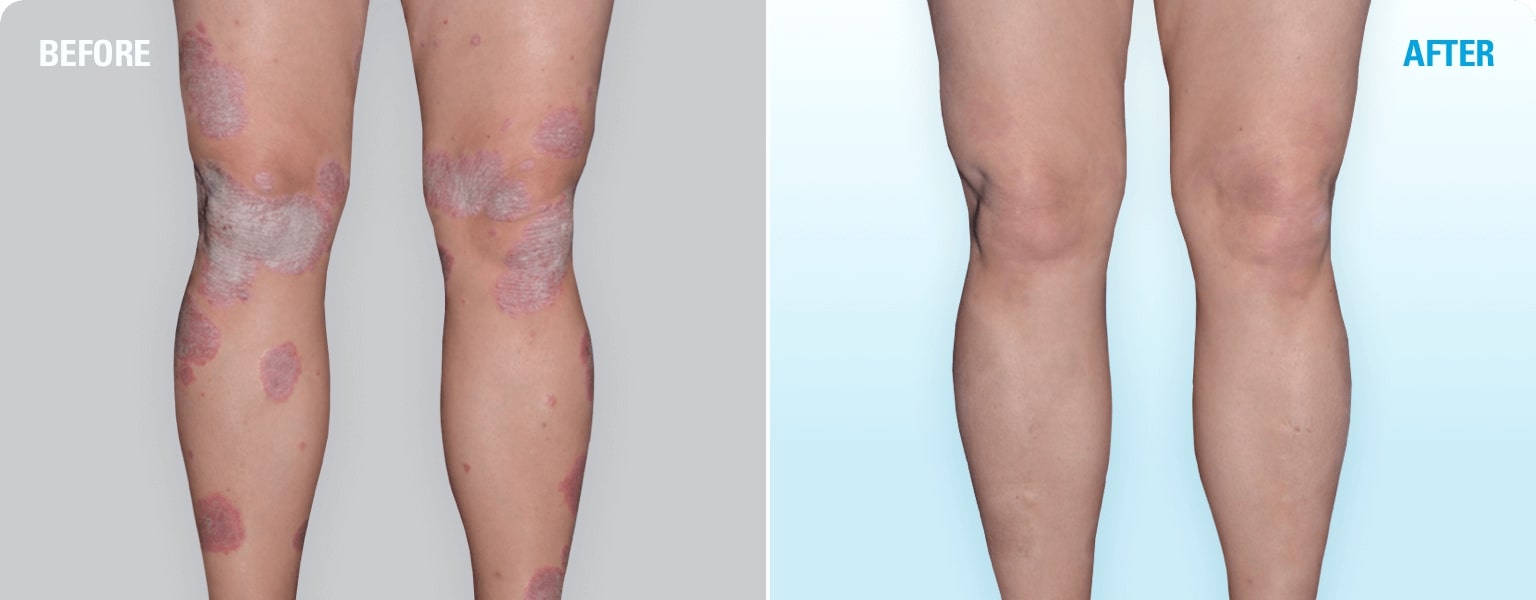 Before And After Pictures Skyrizi® Risankizumab‐rzaa