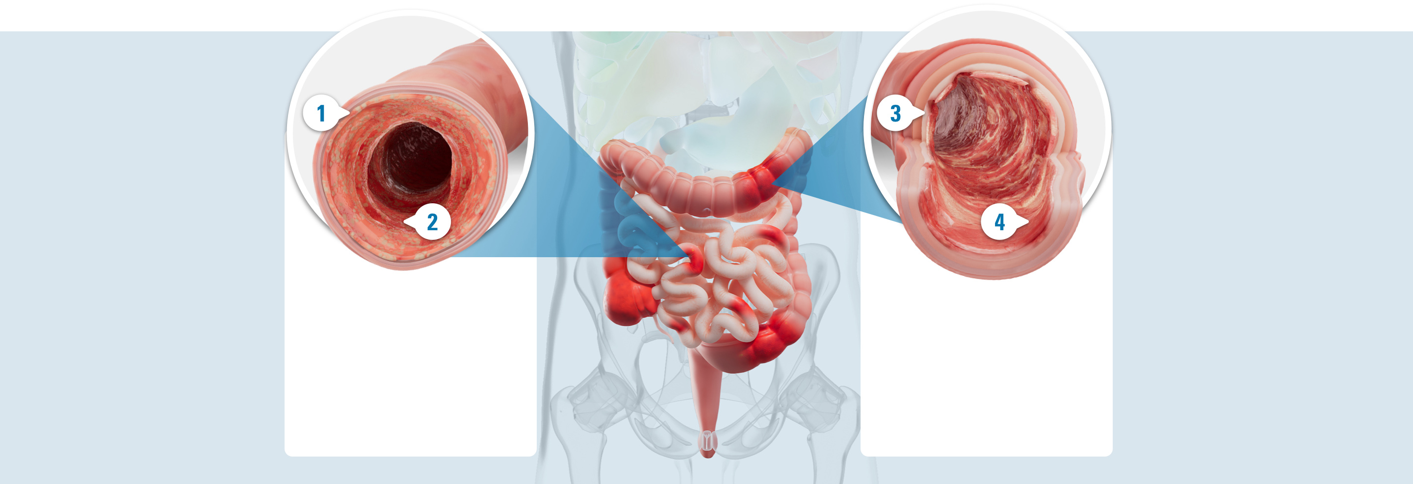 Illustrated damaged colon with 4 callouts: 1. Inflammation, which is an immune response that includes swelling, redness, warmth, and pain. 2. Redness, which is a result of inflammation in the intestinal lining. 3. Ulcers, which are open sores caused by inflammation that can spread and lead to further complications. 4. Bleeding, which is a result of inflammation and open sores (ulcers) that can lead to blood loss and anemia.