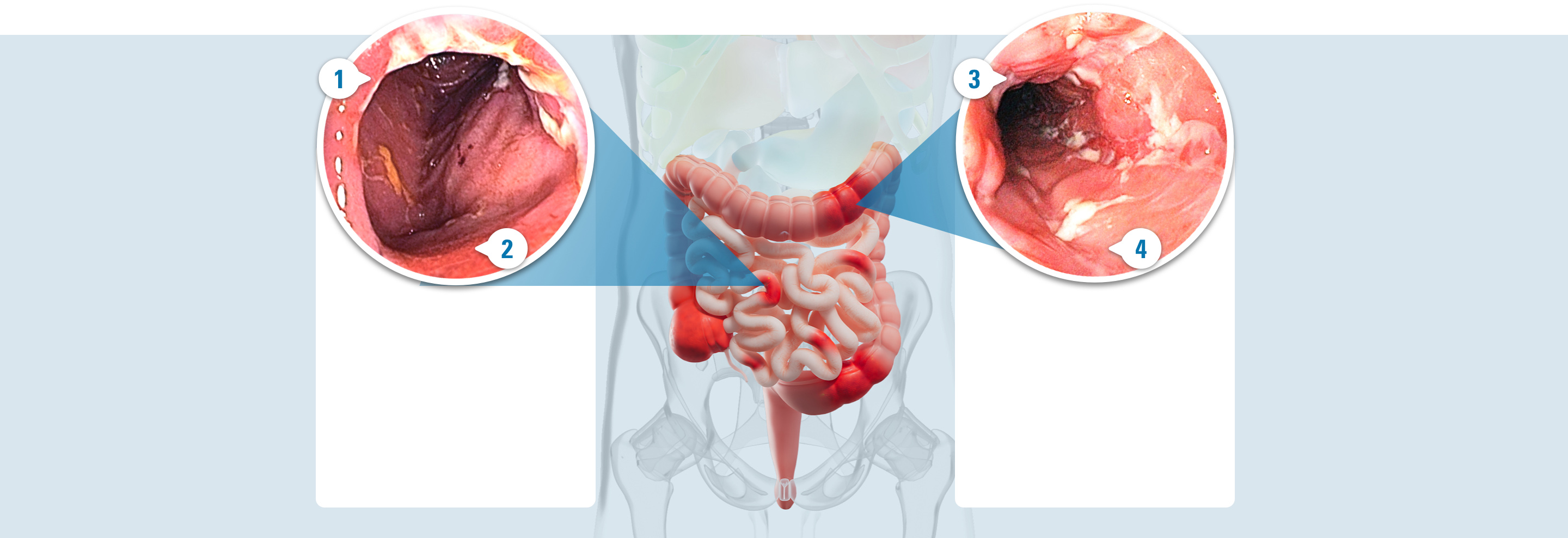 Photo of a damaged colon with 4 callouts: 1. Inflammation, which is an immune response that includes swelling, redness, warmth, and pain. 2. Redness, which is a result of inflammation in the intestinal lining. 3. Ulcers, which are open sores caused by inflammation that can spread and lead to further complications. 4. Bleeding, which is a result of inflammation and open sores (ulcers) that can lead to blood loss and anemia.