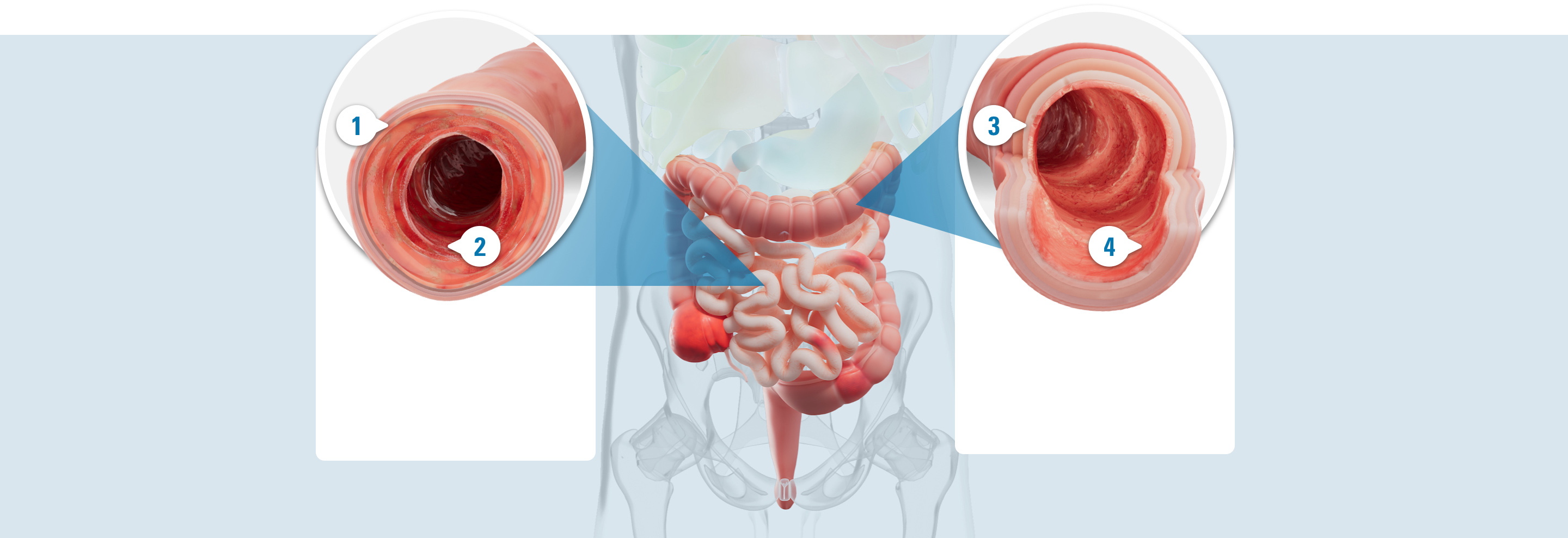 Illustrated healed colon with 4 callouts: 1. Less inflammation. 2. Less redness. 3. Fewer ulcers. 4. Less bleeding.