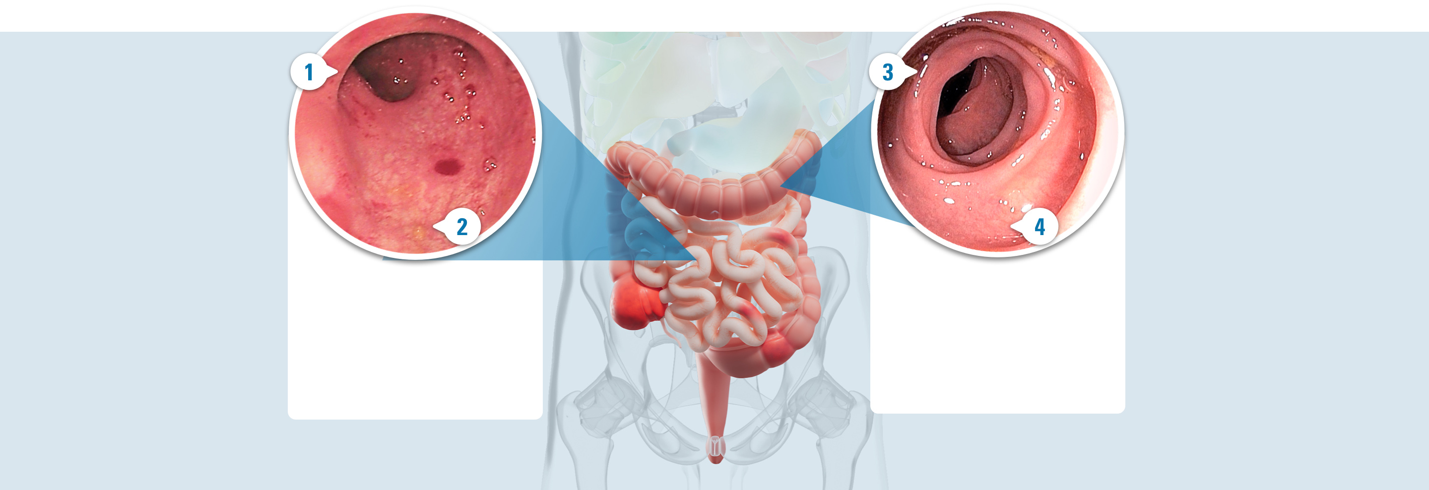 Photo of a healed colon with 4 callouts: 1. Less inflammation. 2. Less redness. 3. Fewer ulcers. 4. Less bleeding.