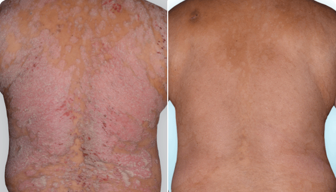 A back with visible psoriasis plaques before skyrizi and a back with 100% clearer skin after skyrizi