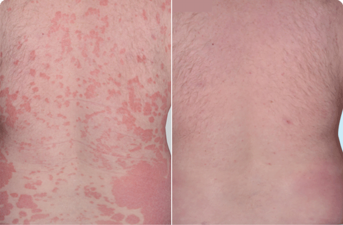 A back with visible psoriasis plaques before skyrizi and a back with 90% clearer skin after skyrizi