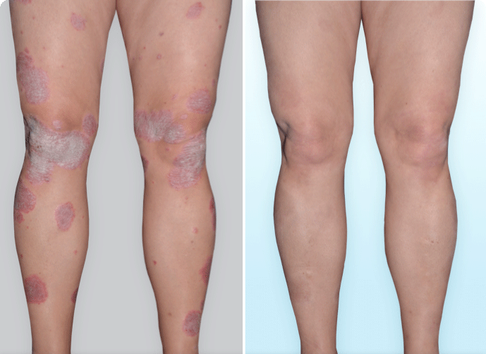 Legs with visible psoriasis plaques before skyrizi and legs with 100% clearer skin after skyrizi