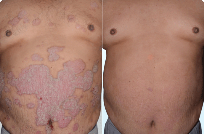 A stomach with visible psoriasis plaques before skyrizi and a stomach with 90% clearer skin after skyrizi