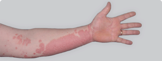 An arm with visible psoriasis plaques before skyrizi and an arm with 100% clearer skin after skyrizi