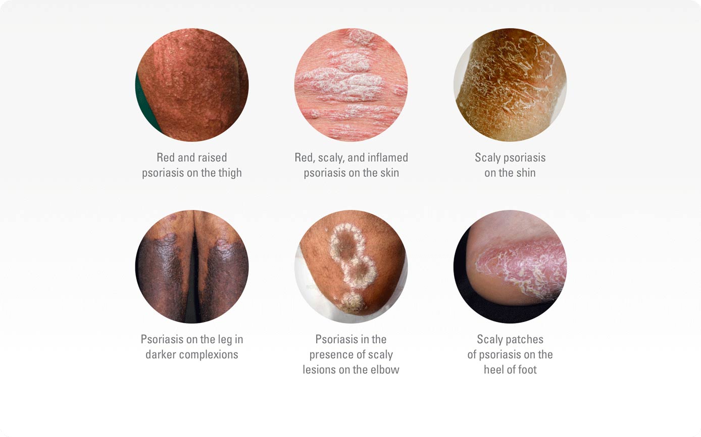 Plaque psoriasis skin types
