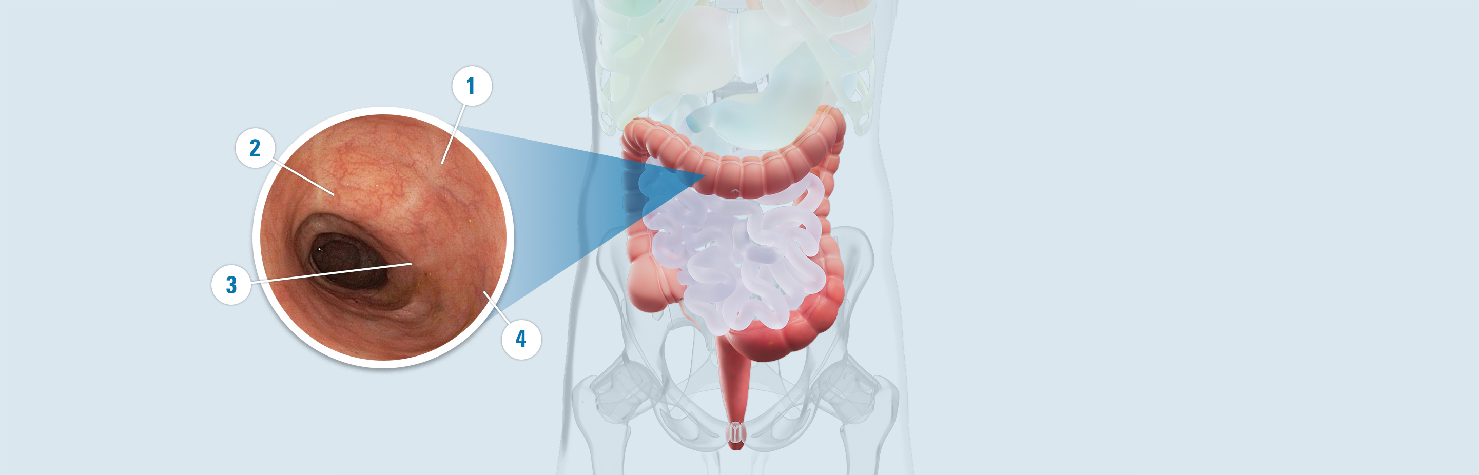 Colon with signs of repair: 1. Fewer ulcers. 2. Less redness. 3. Less bleeding. 4. Smooth lining.