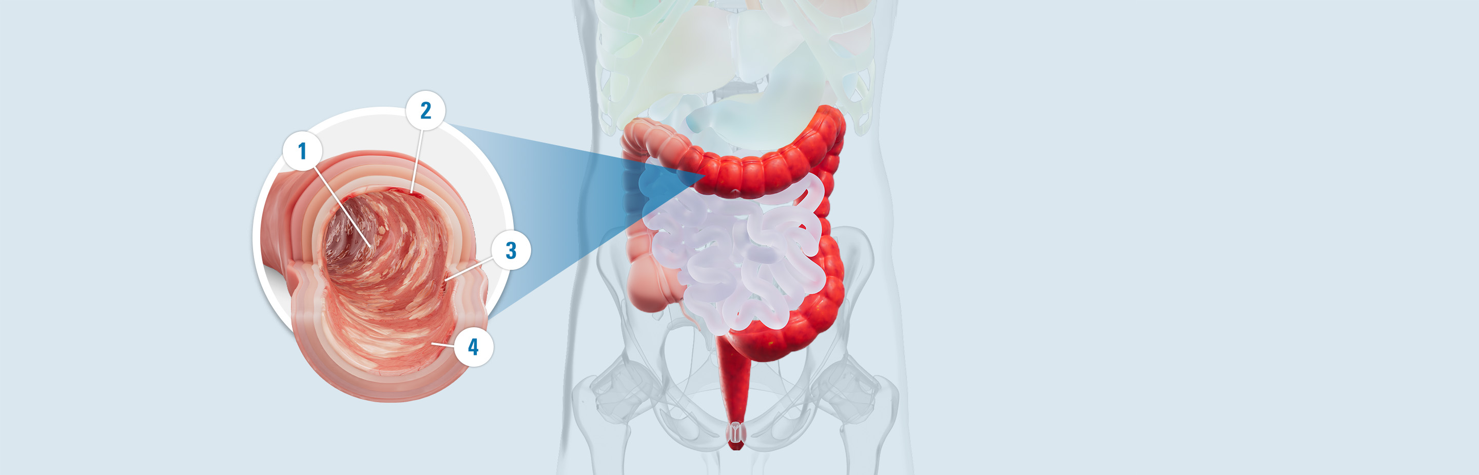 Illustrated colon with signs of damage: 1. Ulcers: open sores caused by inflammation. 2. Redness: a result of inflammation in the colon lining. 3. Bleeding: a result of inflammation and open sores (ulcers). 4. Surface inflammation: an immune response that includes swelling, redness, warmth, and pain.