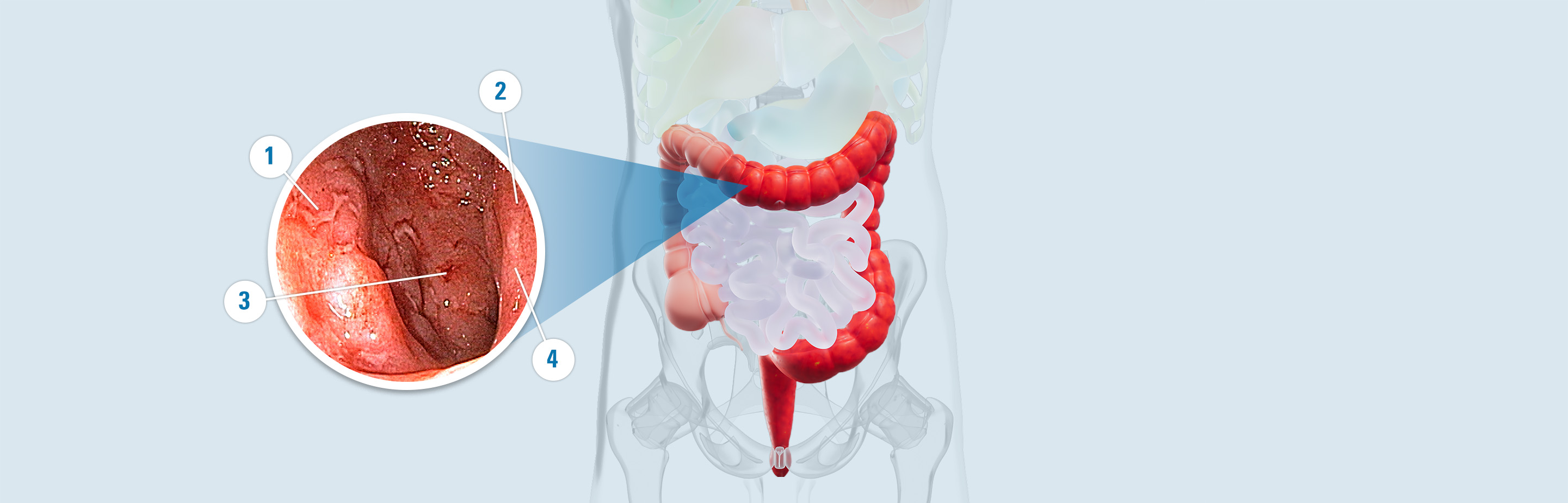 Colon with signs of damage: 1. Ulcers: open sores caused by inflammation. 2. Redness: a result of inflammation in the colon lining. 3. Bleeding: a result of inflammation and open sores (ulcers). 4. Surface inflammation: an immune response that includes swelling, redness, warmth, and pain.