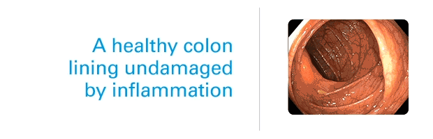 GIF of a healthy colon lining undamaged by inflammation. And then, a colon lining visibly damaged by uncontrolled inflammation.